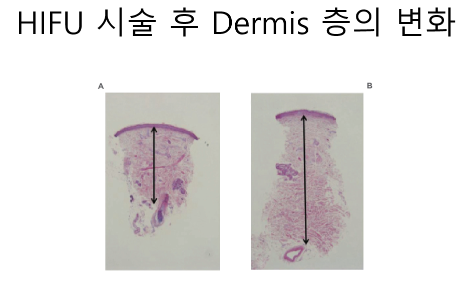[홍대피부과] 제이필의원의 슈링크 vs. 울쎄라 그 차이에 대한 고찰 관련 이미지 5