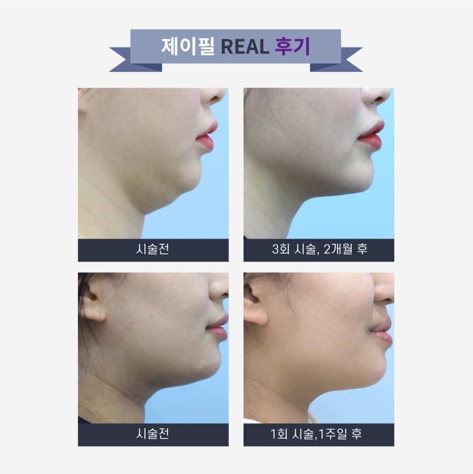 [홍대피부과] 이중턱순삭패키지로 이중턱을 지우자! 관련 이미지 11