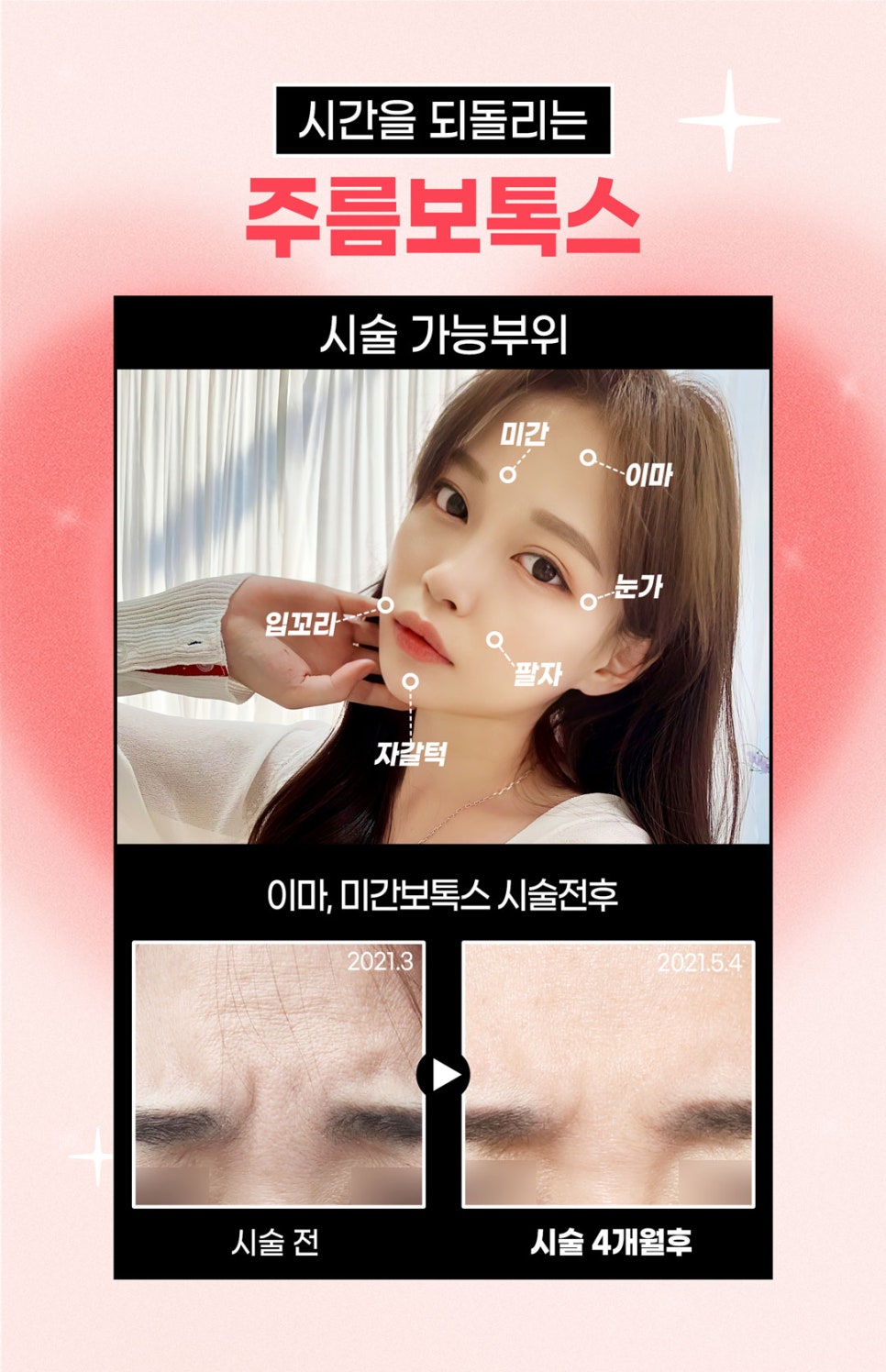사각턱 주름보톡스로 갸름하고 팽팽하게! 관련 이미지 5