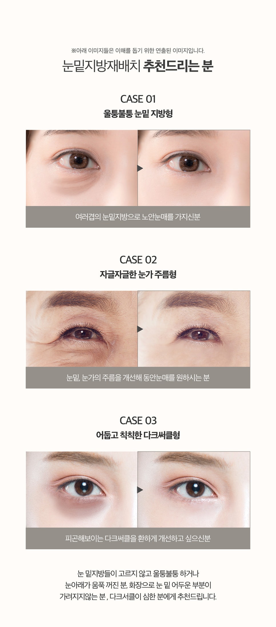 눈밑지방제거방법을 찾는다면? 비수술 비절개로! 관련 이미지 5