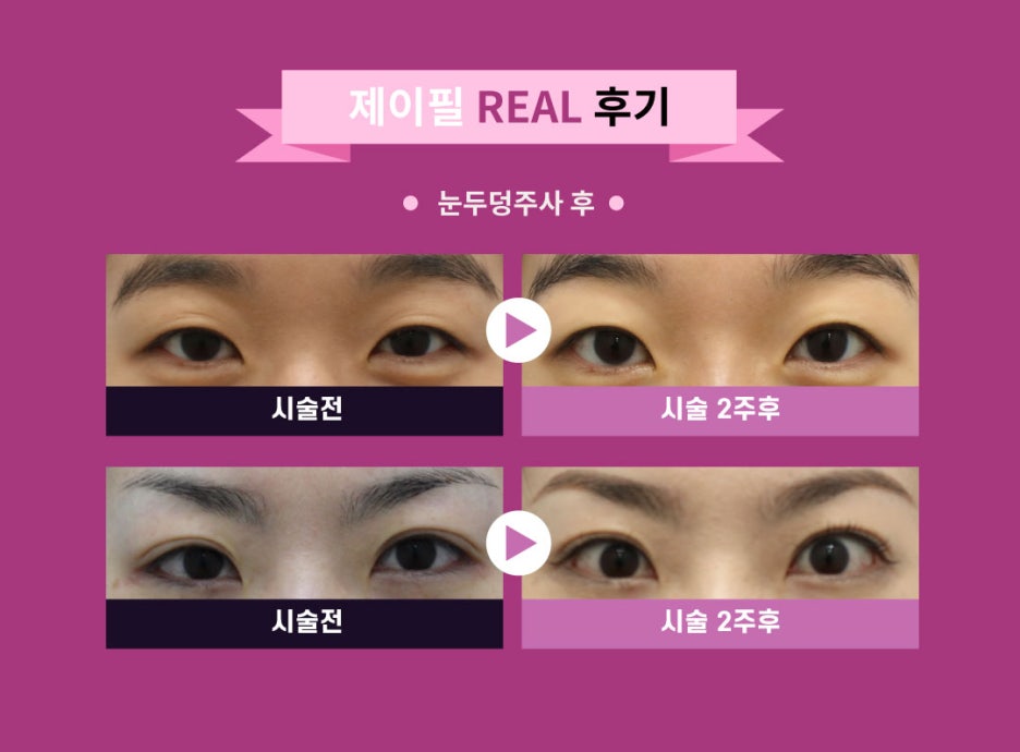 &ldquo;뚜렷한 눈&rdquo; 수술없이 주사로 1분이면 OK 눈두덩이 주사 관련 이미지 4