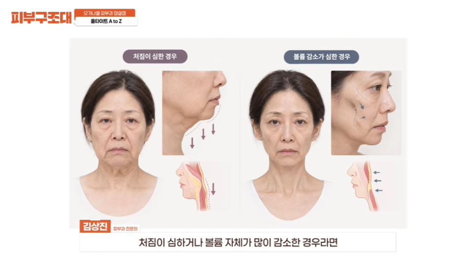 잠실 올타이트 리프팅, 이런 얼굴도 괜찮을까요? 관련 이미지 1