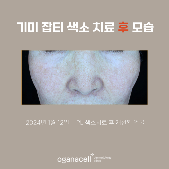 60대 기미 제거 전후 비교 실제사례 관련 이미지 3
