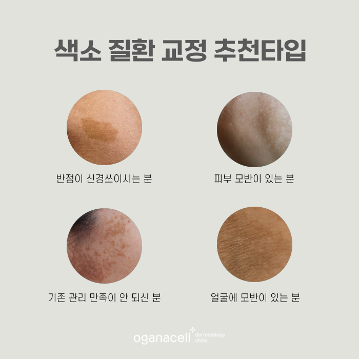 얼굴모반 우리아이한테도 보인다면 관련 이미지 3
