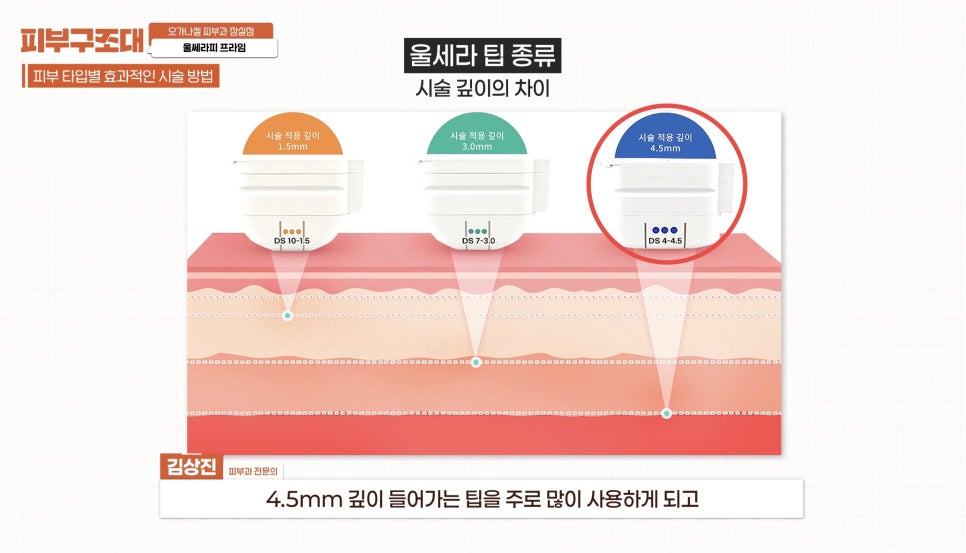 잠실 울쎄라피 프라임 피부과 효과 보는 방법 관련 이미지 7
