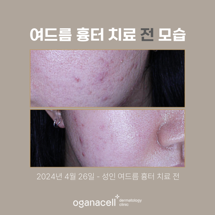 성인여드름 제거 후기 전후 비교 실제사례 관련 이미지 2
