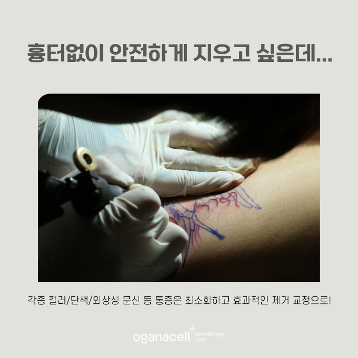 안전하게 문신제거하는 법 관련 이미지 7