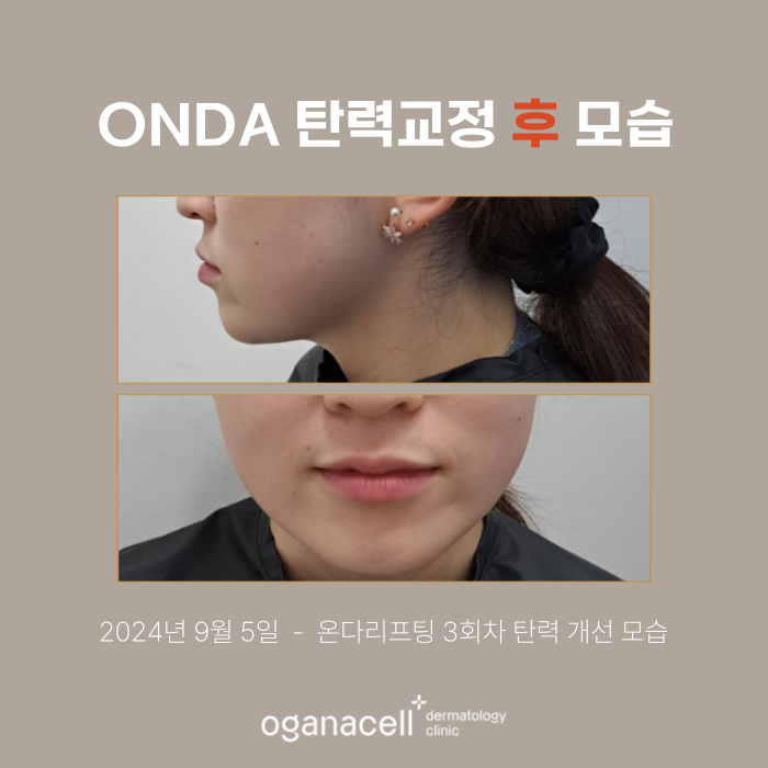 잠실 온다리프팅 관리 전후 비교 실제사례 관련 이미지 3