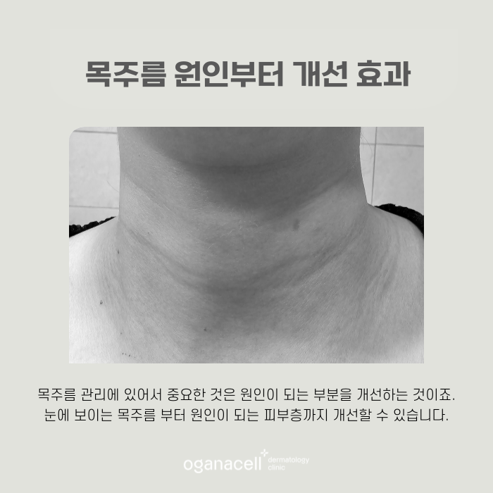 잠실목주름 원인 개선부터 하면 도움돼요 관련 이미지 5