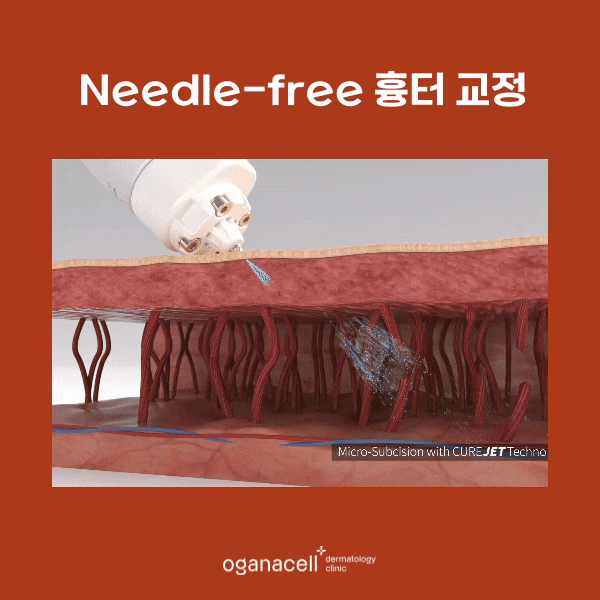 이마여드름흉터 개선 - 잠실피부과 관리법 관련 이미지 6