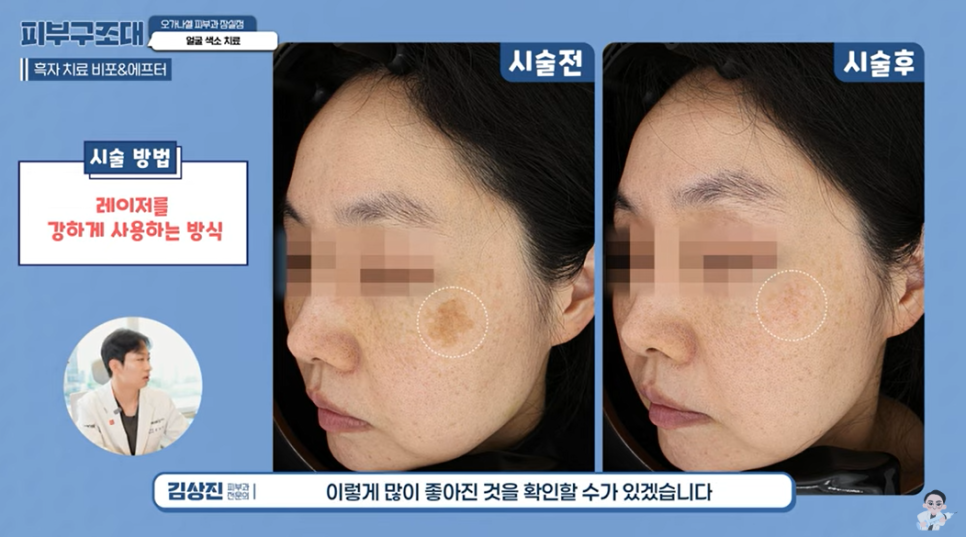 잠실색소제거 점 사마귀 검버섯 잡티 주근깨 맞춤 관리 관련 이미지 8