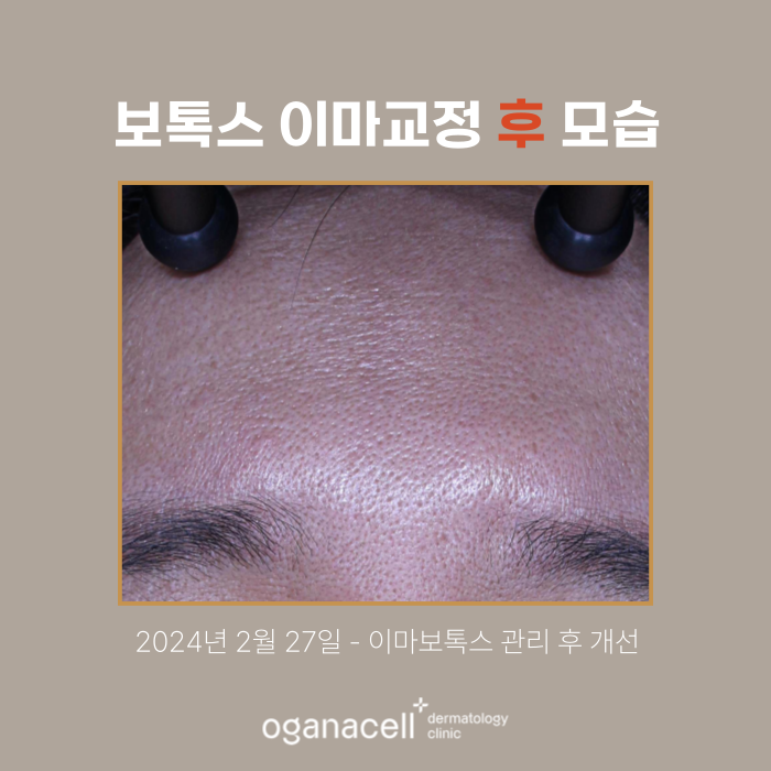 잠실보톡스 이마 쁘띠교정 전후 모습 비교 관련 이미지 3