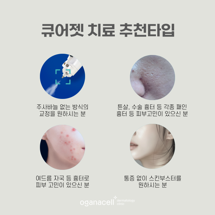큐어젯 흉터치료 하는 방법 관련 이미지 3