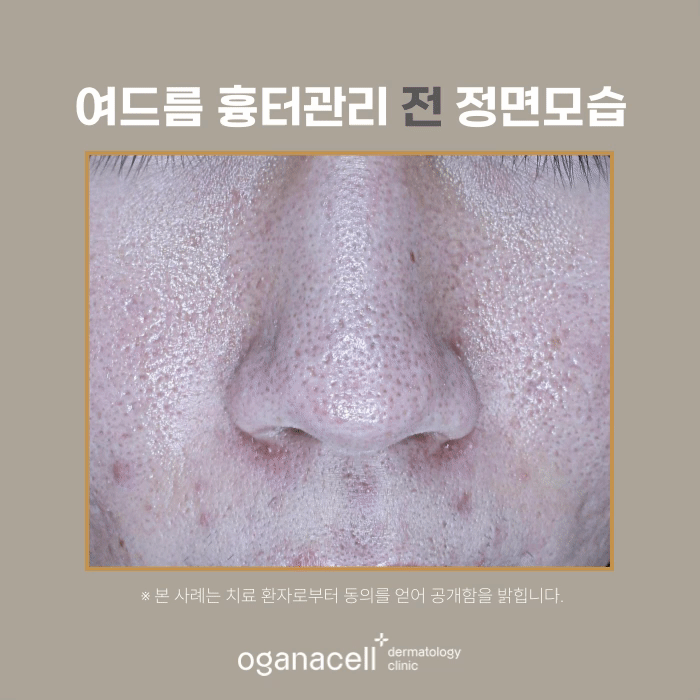 남자여드름피부 잠실피부과 흉터교정 전후 비교 관련 이미지 5