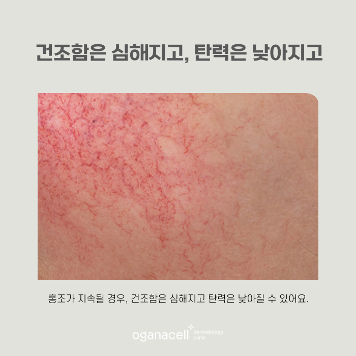 홍조 원인 잡으면 얼굴이 밝아 보여요 관련 이미지 7
