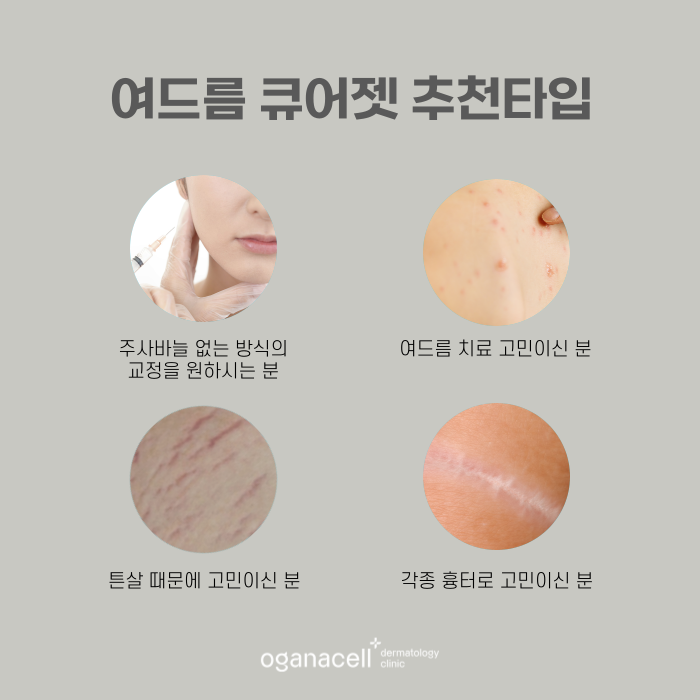 잠실 여드름큐어젯 잘하는 곳 관련 이미지 4