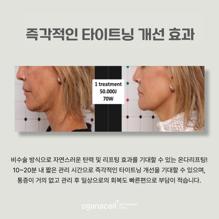 잠실 온다리프팅 얼굴 목 관리 달라야 하는 이유 관련 이미지 5