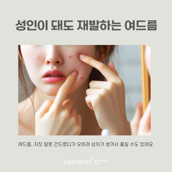 여드름제거 방법 원인부터 없애는 게 좋아요 관련 이미지 7