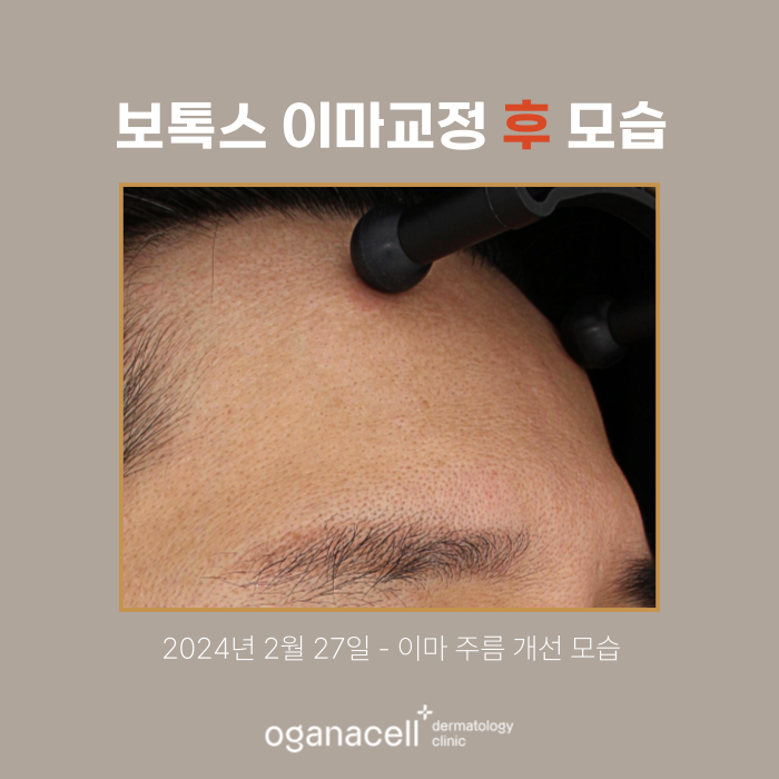 잠실 이마보톡스 전후 비교 후기 관련 이미지 3