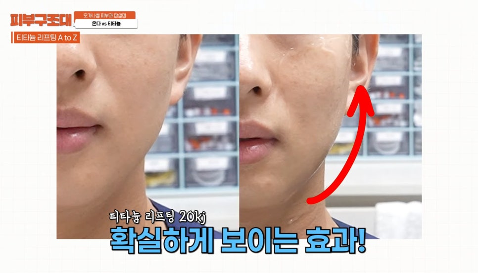잠실 온다 티타늄 리프팅 피부과, 즉각적인 효과를 주는 건? 관련 이미지 11
