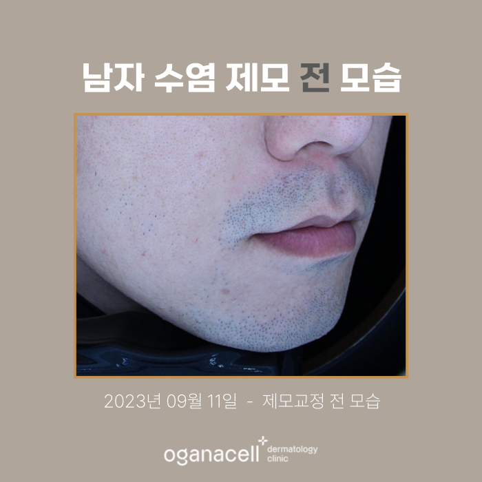 잠실역피부과 제모 남자수염 실제사례(+피부톤개선) 관련 이미지 2