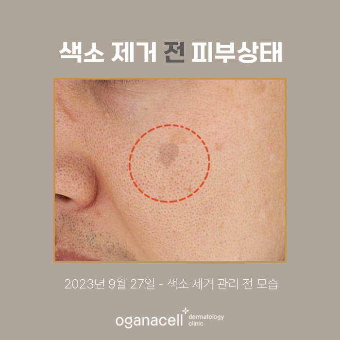 40대색소제거 전후 비교 후기 관련 이미지 2