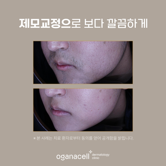잠실 남자수염제모 피부과 관리 전후 비교 관련 이미지 4
