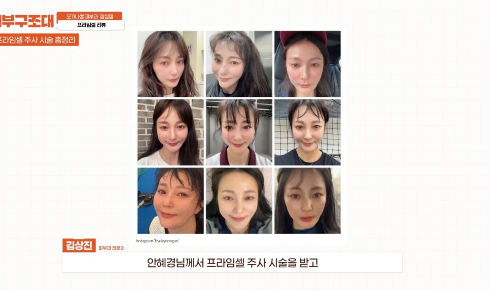 연예인피부관리 프라임셀 직접 해 본 후기 관련 이미지 15