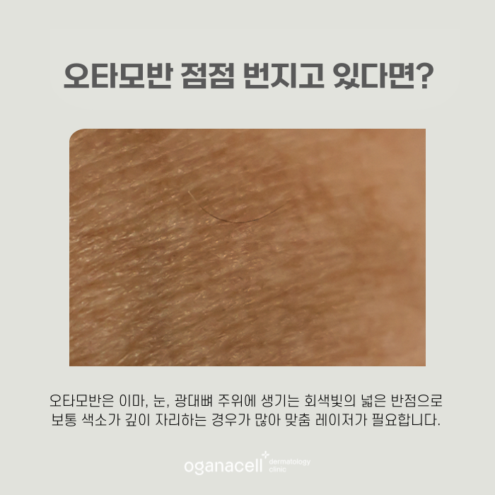 얼굴모반 우리아이한테도 보인다면 관련 이미지 7