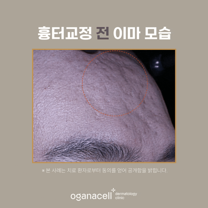 Forehead Scar Correction: Actual Case Before and After Comparison image 4