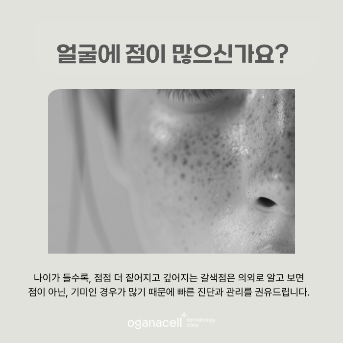 얼굴 갈색점 알고보면 기미일 수 있어요 관련 이미지 4