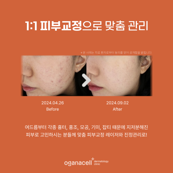 잠실 수험생 할인 이벤트 피부과 관련 이미지 5