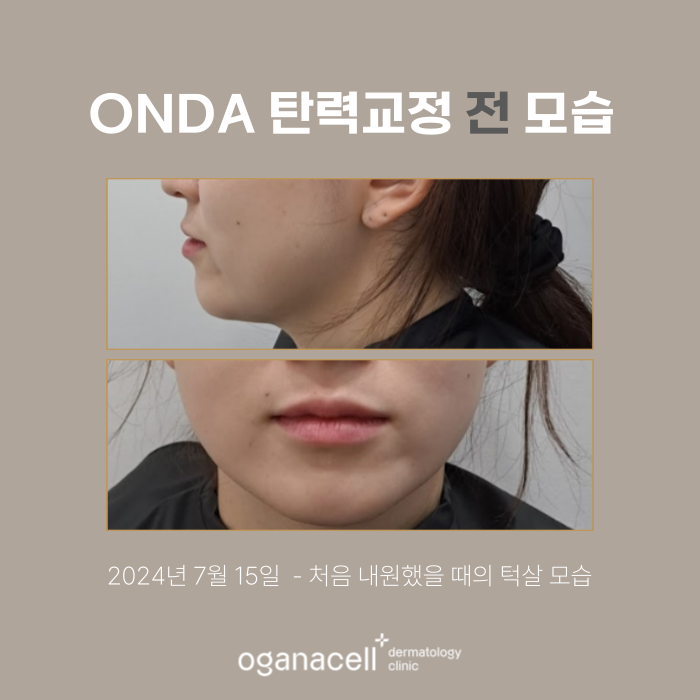 잠실 온다리프팅 관리 전후 비교 실제사례 관련 이미지 2