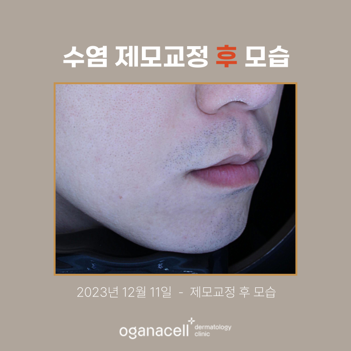 잠실역피부과 제모 남자수염 실제사례(+피부톤개선) 관련 이미지 3