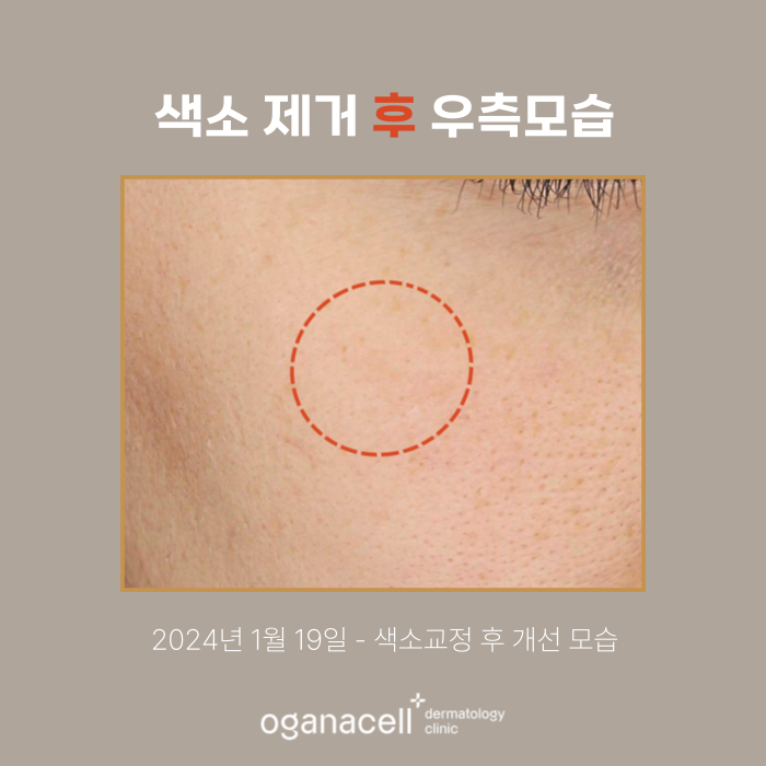 잠실색소제거 실제사례 전후 비교 관련 이미지 3