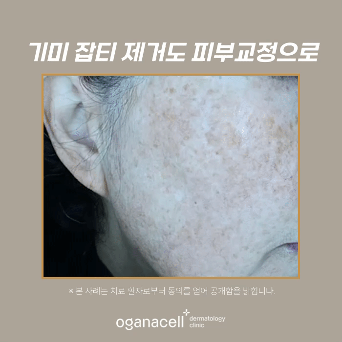 60대 기미 제거 전후 비교 실제사례 관련 이미지 5