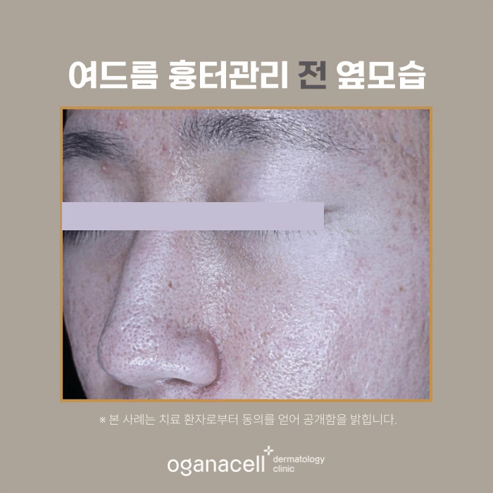 남자여드름피부 잠실피부과 흉터교정 전후 비교 관련 이미지 4