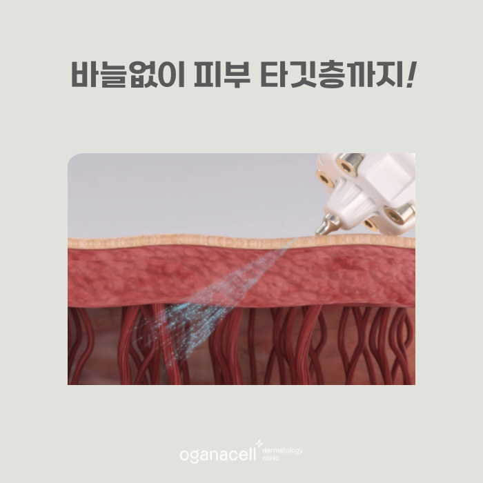 큐어젯 흉터치료 하는 방법 관련 이미지 6