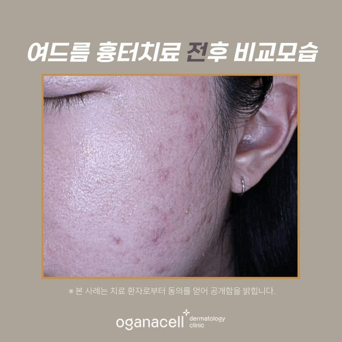 성인여드름 제거 후기 전후 비교 실제사례 관련 이미지 4