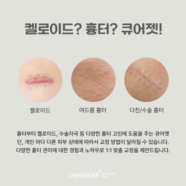 롯데월드타워피부과 흉터 관리 잘하는 곳 관련 이미지 7