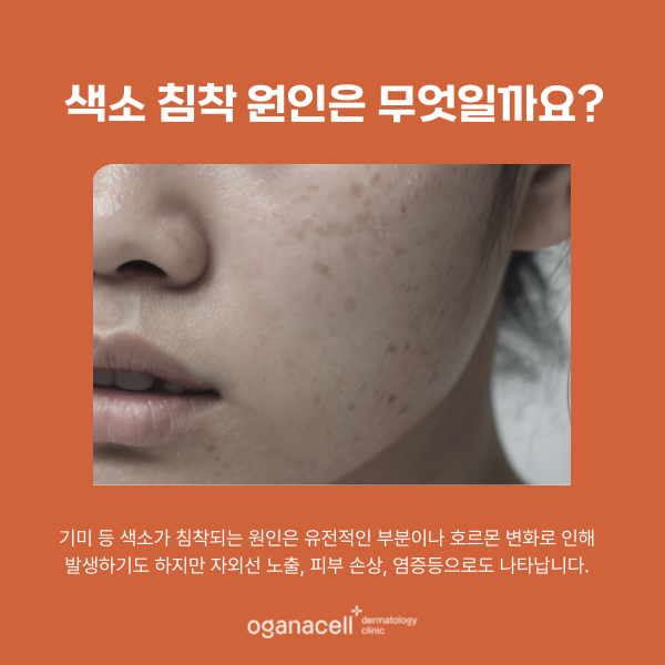 기미 색소 제거 잘하는 잠실 피부과 관련 이미지 4