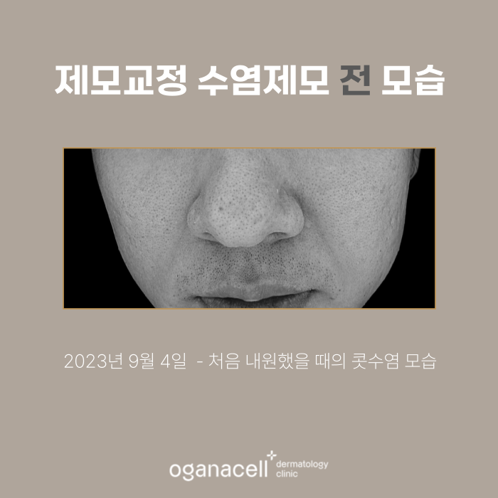남자수염제모 전후 비교 실제사례 관련 이미지 2