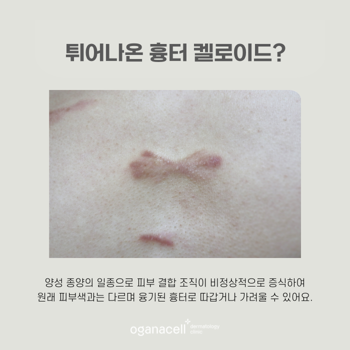 잠실흉터치료잘하는곳 오가나셀 관련 이미지 4