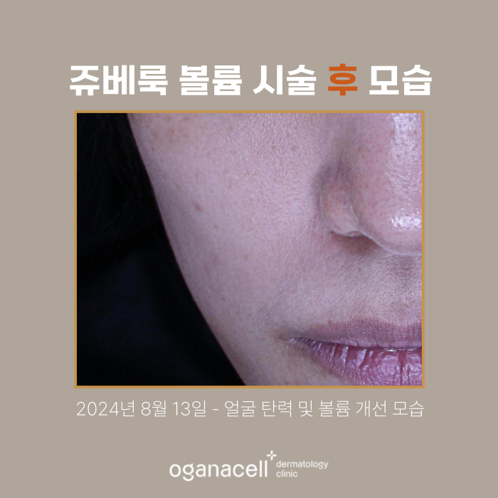 잠실쥬베룩볼륨 전후 비교 실제사례 관련 이미지 3