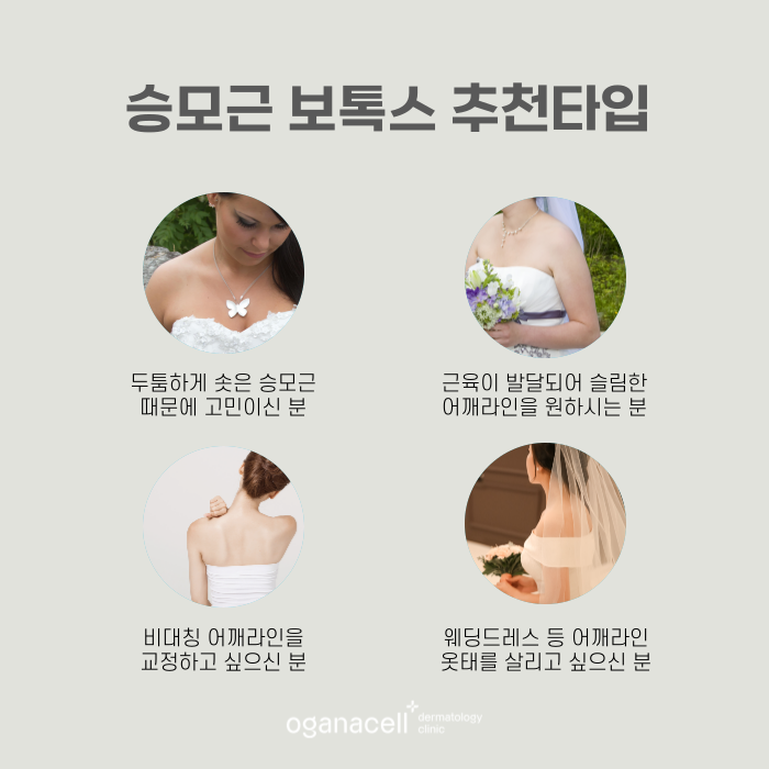 승모근 보톡스 효과 및 유지기간 관련 이미지 3