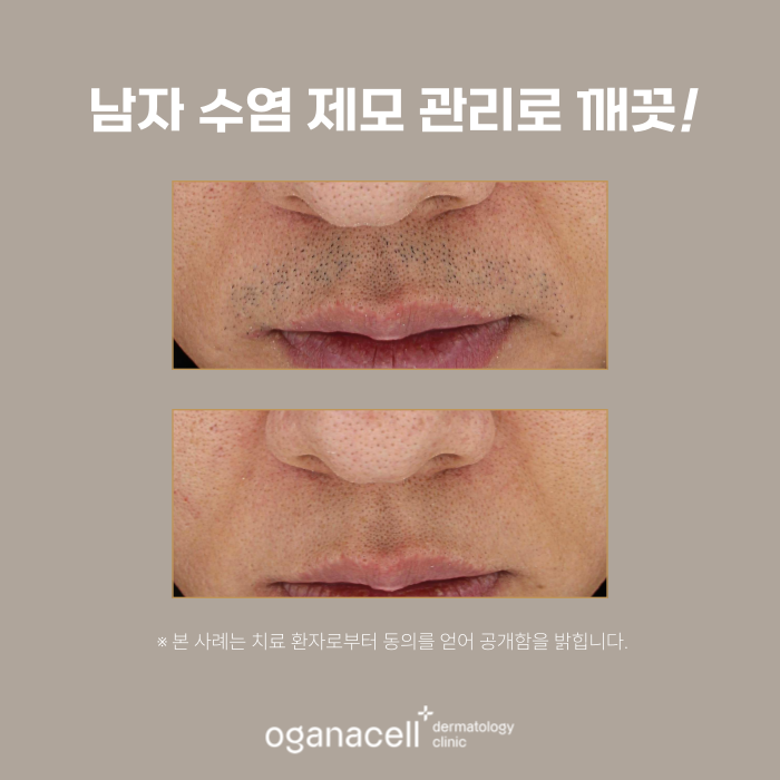 남자수염제모 전후 비교 실제사례 관련 이미지 4