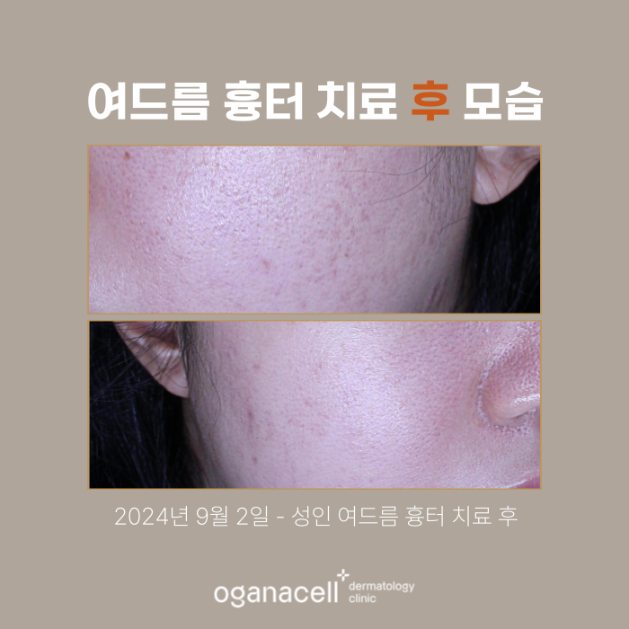성인여드름 제거 후기 전후 비교 실제사례 관련 이미지 3