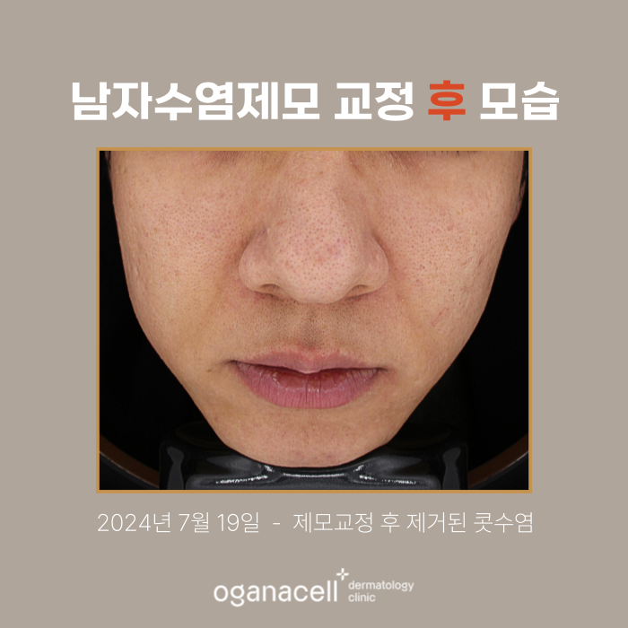 잠실남자제모 전후 비교 후기 관련 이미지 3