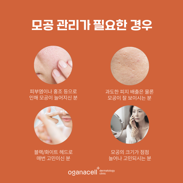 곰보피부 모공 축소보다 알아야 할 핵심 관련 이미지 3