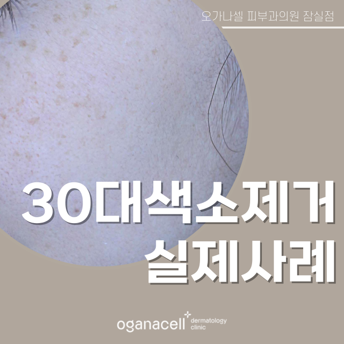 잠실색소제거 실제사례 전후 비교 관련 이미지 1